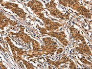 The image on the left is immunohistochemistry of paraffin-embedded Human gastic cancer tissue using CSB-PA254762(CYP2B6 Antibody) at dilution 1/25, on the right is treated with synthetic peptide. (Original magnification: X200)
