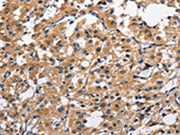 The image on the left is immunohistochemistry of paraffin-embedded Human thyroid cancer tissue using CSB-PA254797(CLEC2D Antibody) at dilution 1/70, on the right is treated with fusion protein. (Original magnification: ×200)