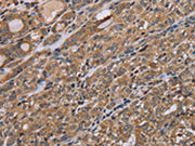 The image on the left is immunohistochemistry of paraffin-embedded Human thyroid cancer tissue using CSB-PA254932(NAA25 Antibody) at dilution 1/40, on the right is treated with synthetic peptide. (Original magnification: ×200)