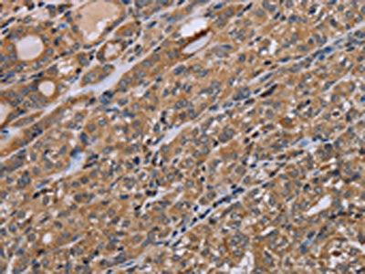 The image on the left is immunohistochemistry of paraffin-embedded Human thyroid cancer tissue using CSB-PA254932(NAA25 Antibody) at dilution 1/40, on the right is treated with synthetic peptide. (Original magnification: ×200)
