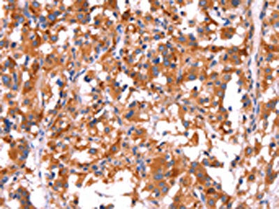 The image on the left is immunohistochemistry of paraffin-embedded Human thyroid cancer tissue using CSB-PA254989(GCG Antibody) at dilution 1/40, on the right is treated with synthetic peptide. (Original magnification: ×200)