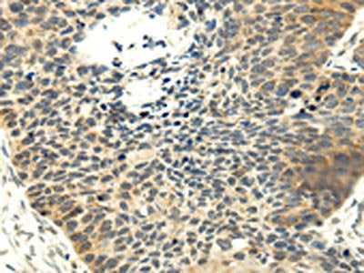 The image on the left is immunohistochemistry of paraffin-embedded Human esophagus cancer tissue using CSB-PA255018(MAP3K7 Antibody) at dilution 1/20, on the right is treated with fusion protein. (Original magnification: ×200)