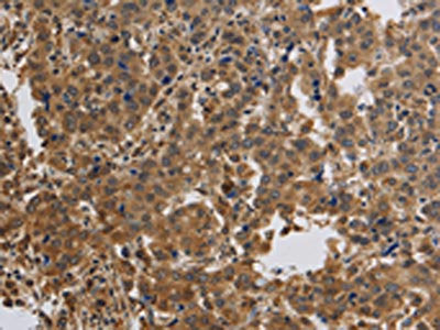 The image on the left is immunohistochemistry of paraffin-embedded Human liver cancer tissue using CSB-PA255042(KCNMB4 Antibody) at dilution 1/40, on the right is treated with synthetic peptide. (Original magnification: ×200)