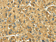 The image on the left is immunohistochemistry of paraffin-embedded Human liver cancer tissue using CSB-PA255218(LEP Antibody) at dilution 1/20, on the right is treated with fusion protein. (Original magnification: ×200)