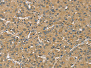 The image on the left is immunohistochemistry of paraffin-embedded Human liver cancer tissue using CSB-PA255275(SLC39A3 Antibody) at dilution 1/30, on the right is treated with synthetic peptide. (Original magnification: ×200)