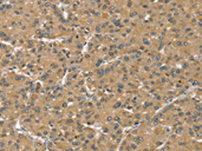 The image on the left is immunohistochemistry of paraffin-embedded Human liver cancer tissue using CSB-PA255275(SLC39A3 Antibody) at dilution 1/30, on the right is treated with synthetic peptide. (Original magnification: ×200)