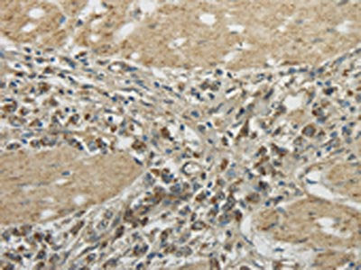The image on the left is immunohistochemistry of paraffin-embedded Human gastric cancer tissue using CSB-PA255282(TRIB2 Antibody) at dilution 1/45, on the right is treated with fusion protein. (Original magnification: ×200)