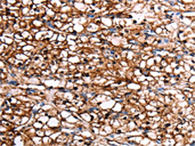 The image on the left is immunohistochemistry of paraffin-embedded Human renal cancer tissue using CSB-PA255283(GDF15 Antibody) at dilution 1/7, on the right is treated with fusion protein. (Original magnification: ×200)