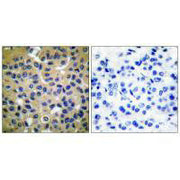 Immunohistochemical analysis of paraffin-embedded human breast carcinoma tissue using Collagen II antibody.