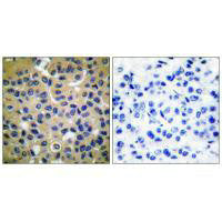 Immunohistochemical analysis of paraffin-embedded human breast carcinoma tissue using Collagen II antibody.