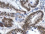 The image on the left is immunohistochemistry of paraffin-embedded Human colon cancer tissue using CSB-PA255528(LRP5 Antibody) at dilution 1/55, on the right is treated with synthetic peptide. (Original magnification: ×200)