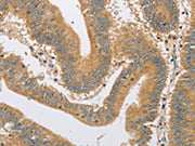 The image on the left is immunohistochemistry of paraffin-embedded Human colon cancer tissue using CSB-PA255560(ARHGEF1 Antibody) at dilution 1/60, on the right is treated with fusion protein. (Original magnification: ×200)