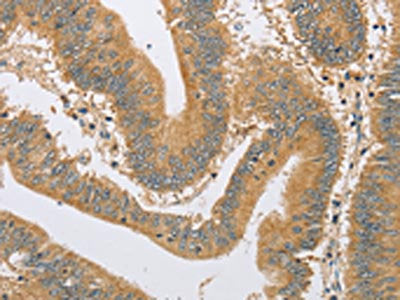 The image on the left is immunohistochemistry of paraffin-embedded Human colon cancer tissue using CSB-PA255560(ARHGEF1 Antibody) at dilution 1/60, on the right is treated with fusion protein. (Original magnification: ×200)