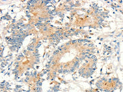 The image on the left is immunohistochemistry of paraffin-embedded Human colon cancer tissue using CSB-PA255651(MMP9 Antibody) at dilution 1/20, on the right is treated with fusion protein. (Original magnification: ×200)
