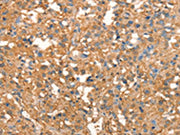 The image on the left is immunohistochemistry of paraffin-embedded Human thyroid cancer tissue using CSB-PA255746(CRELD1 Antibody) at dilution 1/40, on the right is treated with synthetic peptide. (Original magnification: ×200)
