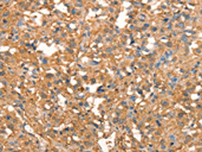 The image on the left is immunohistochemistry of paraffin-embedded Human thyroid cancer tissue using CSB-PA255746(CRELD1 Antibody) at dilution 1/40, on the right is treated with synthetic peptide. (Original magnification: ×200)