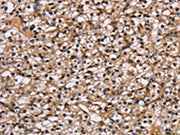 The image on the left is immunohistochemistry of paraffin-embedded Human prostate cancer tissue using CSB-PA255769(NUP62 Antibody) at dilution 1/50, on the right is treated with fusion protein. (Original magnification: ×200)