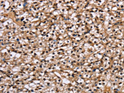 The image on the left is immunohistochemistry of paraffin-embedded Human prostate cancer tissue using CSB-PA255769(NUP62 Antibody) at dilution 1/50, on the right is treated with fusion protein. (Original magnification: ×200)