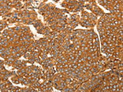 The image on the left is immunohistochemistry of paraffin-embedded Human liver cancer tissue using CSB-PA255809(SFRP1 Antibody) at dilution 1/80, on the right is treated with synthetic peptide. (Original magnification: ×200)
