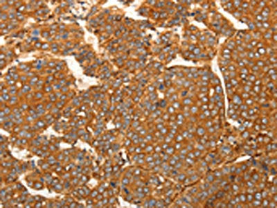 The image on the left is immunohistochemistry of paraffin-embedded Human liver cancer tissue using CSB-PA255809(SFRP1 Antibody) at dilution 1/80, on the right is treated with synthetic peptide. (Original magnification: ×200)