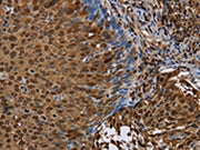 The image on the left is immunohistochemistry of paraffin-embedded Human cervical cancer tissue using CSB-PA255815(NRP2 Antibody) at dilution 1/45, on the right is treated with synthetic peptide. (Original magnification: ×200)