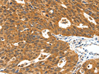 The image on the left is immunohistochemistry of paraffin-embedded Human ovarian cancer tissue using CSB-PA255864(PLAT Antibody) at dilution 1/40, on the right is treated with synthetic peptide. (Original magnification: ×200)