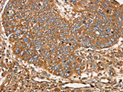 The image on the left is immunohistochemistry of paraffin-embedded Human lung cancer tissue using CSB-PA256001(SCD Antibody) at dilution 1/25, on the right is treated with synthetic peptide. (Original magnification: ×200)