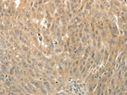 The image on the left is immunohistochemistry of paraffin-embedded Human ovarian cancer tissue using CSB-PA256025(MAP4 Antibody) at dilution 1/10, on the right is treated with fusion protein. (Original magnification: ×200)