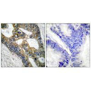 Immunohistochemical analysis of paraffin-embedded human colon carcinoma tissue using MMP-7 antibody.