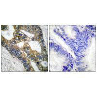 Immunohistochemical analysis of paraffin-embedded human colon carcinoma tissue using MMP-7 antibody.