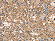The image on the left is immunohistochemistry of paraffin-embedded Human thyroid cancer tissue using CSB-PA256217(CRELD1 Antibody) at dilution 1/40, on the right is treated with synthetic peptide. (Original magnification: ×200)