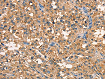 The image on the left is immunohistochemistry of paraffin-embedded Human thyroid cancer tissue using CSB-PA256217(CRELD1 Antibody) at dilution 1/40, on the right is treated with synthetic peptide. (Original magnification: ×200)
