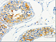 The image on the left is immunohistochemistry of paraffin-embedded Human skin tissue using CSB-PA256310(CAP1 Antibody) at dilution 1/50, on the right is treated with fusion protein. (Original magnification: ×200)