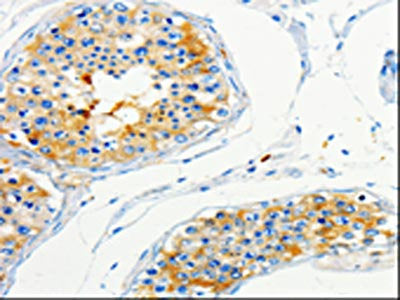 The image on the left is immunohistochemistry of paraffin-embedded Human skin tissue using CSB-PA256310(CAP1 Antibody) at dilution 1/50, on the right is treated with fusion protein. (Original magnification: ×200)