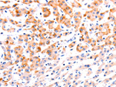 The image on the left is immunohistochemistry of paraffin-embedded Human liver cancer tissue using CSB-PA256498(EFNA1 Antibody) at dilution 1/37, on the right is treated with fusion protein. (Original magnification: ×200)