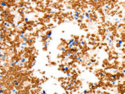 The image on the left is immunohistochemistry of paraffin-embedded Human ovarian cancer tissue using CSB-PA256733(SLC2A5 Antibody) at dilution 1/12, on the right is treated with synthetic peptide. (Original magnification: ×200)