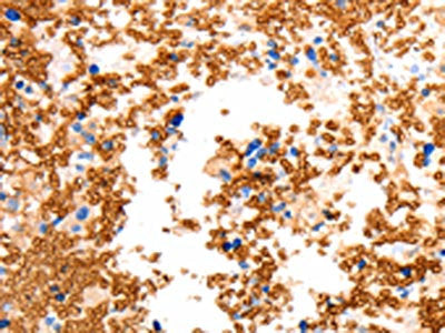 The image on the left is immunohistochemistry of paraffin-embedded Human ovarian cancer tissue using CSB-PA256733(SLC2A5 Antibody) at dilution 1/12, on the right is treated with synthetic peptide. (Original magnification: ×200)