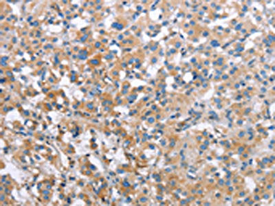 The image on the left is immunohistochemistry of paraffin-embedded Human thyroid cancer tissue using CSB-PA256752(MCL1 Antibody) at dilution 1/60, on the right is treated with synthetic peptide. (Original magnification: ×200)