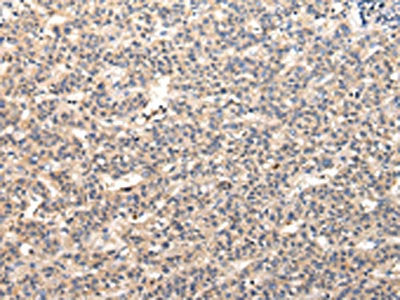 The image on the left is immunohistochemistry of paraffin-embedded Human liver cancer tissue using CSB-PA256766(VPS37A Antibody) at dilution 1/30, on the right is treated with fusion protein. (Original magnification: ×200)