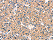 The image on the left is immunohistochemistry of paraffin-embedded Human liver cancer tissue using CSB-PA256995(ARHGAP4 Antibody) at dilution 1/25, on the right is treated with synthetic peptide. (Original magnification: ×200)