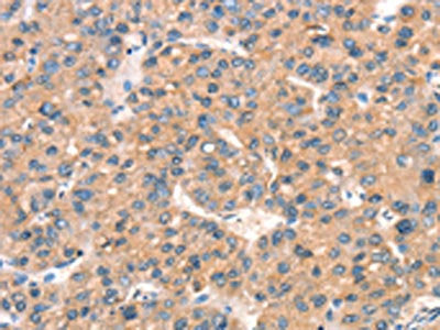 The image on the left is immunohistochemistry of paraffin-embedded Human liver cancer tissue using CSB-PA256995(ARHGAP4 Antibody) at dilution 1/25, on the right is treated with synthetic peptide. (Original magnification: ×200)