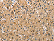 The image on the left is immunohistochemistry of paraffin-embedded Human liver cancer tissue using CSB-PA257054(ARMCX1 Antibody) at dilution 1/40, on the right is treated with fusion protein. (Original magnification: ×200)