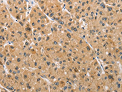 The image on the left is immunohistochemistry of paraffin-embedded Human liver cancer tissue using CSB-PA257054(ARMCX1 Antibody) at dilution 1/40, on the right is treated with fusion protein. (Original magnification: ×200)