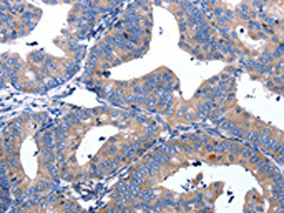The image on the left is immunohistochemistry of paraffin-embedded Human cervical cancer tissue using CSB-PA257161(APAF1 Antibody) at dilution 1/25, on the right is treated with synthetic peptide. (Original magnification: ×200)