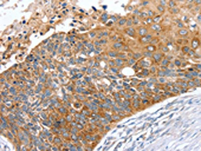 The image on the left is immunohistochemistry of paraffin-embedded Human esophagus cancer tissue using CSB-PA257285(SNX27 Antibody) at dilution 1/40, on the right is treated with fusion protein. (Original magnification: ×200)