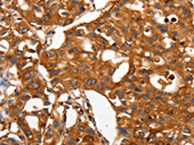 The image on the left is immunohistochemistry of paraffin-embedded Human lung cancer tissue using CSB-PA257305(CAP2 Antibody) at dilution 1/50, on the right is treated with fusion protein. (Original magnification: ×200)