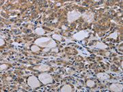 The image on the left is immunohistochemistry of paraffin-embedded Human thyroid cancer tissue using CSB-PA257308(NAIP Antibody) at dilution 1/30, on the right is treated with synthetic peptide. (Original magnification: ×200)