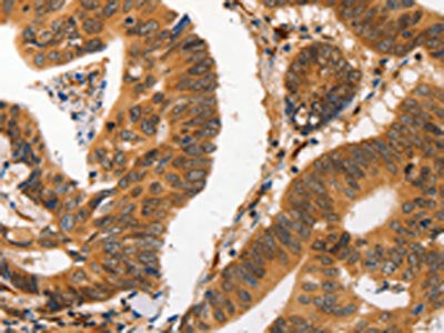 The image on the left is immunohistochemistry of paraffin-embedded Human colon cancer tissue using CSB-PA257327(CA2 Antibody) at dilution 1/20, on the right is treated with fusion protein. (Original magnification: ×200)