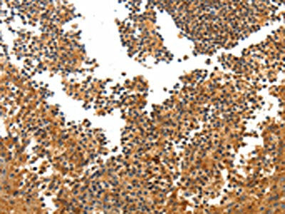 The image on the left is immunohistochemistry of paraffin-embedded Human tonsil tissue using CSB-PA257364(TERT Antibody) at dilution 1/40, on the right is treated with synthetic peptide. (Original magnification: ×200)