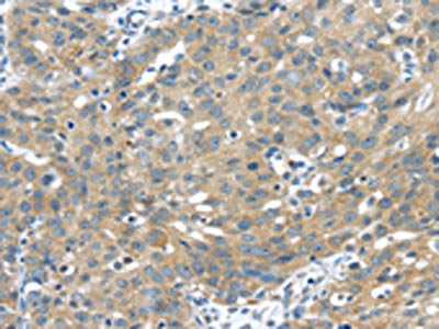 The image on the left is immunohistochemistry of paraffin-embedded Human breast cancer tissue using CSB-PA257638(UCHL3 Antibody) at dilution 1/35, on the right is treated with fusion protein. (Original magnification: ×200)